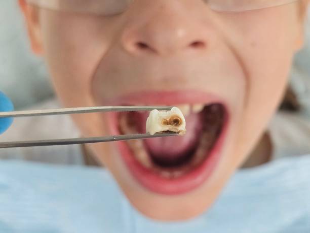 Best Urgent Care for Lost Fillings or Crowns in Forest Oaks, NC